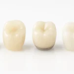 Dental Ceramics Guide: Zirconia Crowns Porcelain Veneers and Implants